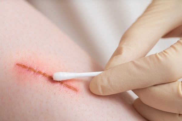 Wound Care Therapy